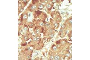 Formalin-fixed and paraffin-embedded human cancer tissue reacted with the primary antibody, which was peroxidase-conjugated to the secondary antibody, followed by DAB staining. (Nemo-Like Kinase Antikörper  (C-Term))