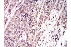 Immunohistochemical analysis of paraffin-embedded human bladder cancer tissues using TBLR1 mouse mAb with DAB staining. (TBL1XR1 Antikörper)