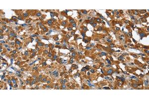 Immunohistochemistry of paraffin-embedded Human thyroid cancer using BGN Polyclonal Antibody at dilution of 1:50 (Biglycan Antikörper)