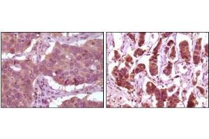 Immunohistochemical analysis of paraffin-embedded human lung carcinoma (left) and breast carcinoma (right) showing cytoplasmic localization using ERK2 antibody with DAB staining.