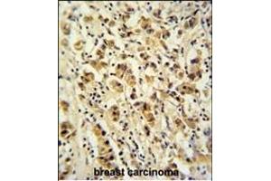 DDX49 Antibody (C-term) (ABIN653921 and ABIN2843155) immunohistochemistry analysis in formalin fixed and paraffin embedded human breast carcinoma followed by peroxidase conjugation of the secondary antibody and DAB staining. (DDX49 Antikörper  (C-Term))