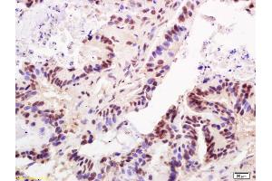 Formalin-fixed and paraffin embedded human colon carcinoma labeled with Anti-TRF2 Polyclonal Antibody, Unconjugated (ABIN736418) at 1:200 followed by conjugation to the secondary antibody and DAB staining (TBPL1 Antikörper  (AA 301-400))