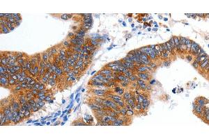 Immunohistochemistry of paraffin-embedded Human colon cancer tissue using KCNC2 Polyclonal Antibody at dilution 1:100 (KCNC2 Antikörper)