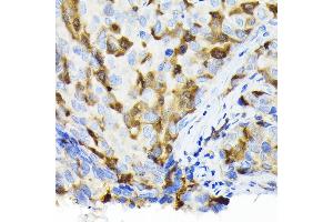 Immunohistochemistry of paraffin-embedded human breast cancer using Thymidine Kinase 1 Rabbit pAb (ABIN6132726, ABIN6149198, ABIN6149199 and ABIN6221245) at dilution of 1:100 (40x lens).