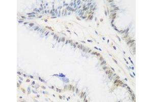 Immunohistochemistry of paraffin-embedded Human stomach using IGF2BP3 Polyclonal Antibody at dilution of 1:200 (40x lens). (IGF2BP3 Antikörper)