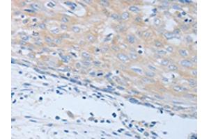 The image on the left is immunohistochemistry of paraffin-embedded Human cervical cancer tissue using ABIN7190248(CHRFAM7A Antibody) at dilution 1/40, on the right is treated with synthetic peptide. (CHRNA7 Antikörper)