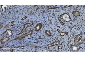 IHC analysis of PARP using anti-PARP antibody (ABIN7602277). (PARP1 Antikörper  (AA 670-858))