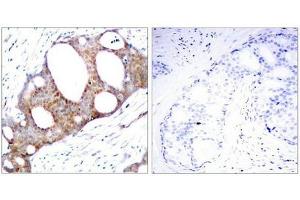 Immunohistochemical analysis of paraffin-embedded human breast carcinoma tissue using GSK3a(Phospho-Ser21) Antibody(left) or the same antibody preincubated with blocking peptide(right).
