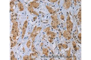 Immunohistochemistry of Human thyroid cancer using CLEC1A Polyclonal Antibody at dilution of 1:40 (CLEC1A Antikörper)