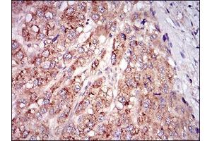Immunohistochemical analysis of paraffin-embedded liver cancer tissues using MSTN mouse mAb with DAB staining. (MSTN Antikörper  (AA 24-266))