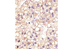 (ABIN387816 and ABIN2843905) staining EGFR in human hepatic carcinoma sections by Immunohistochemistry (IHC-P - paraformaldehyde-fixed, paraffin-embedded sections). (EGFR Antikörper)
