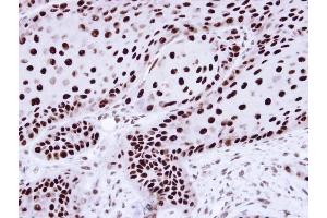 Immunohistochemical staining of paraffin-embedded Cal27 Xenograft using hnRNP C1/C2 antibody at a dilution of 1:100 (HNRNPC Antikörper)