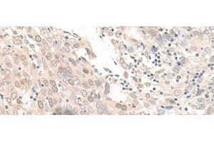 Immunohistochemistry of paraffin-embedded Human prost at e cancer tissue using OLA1 Polyclonal Antibody at dilution of 1:45(x200) (OLA1 Antikörper)