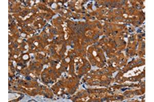 The image on the left is immunohistochemistry of paraffin-embedded Human thyroid cancer tissue using ABIN7191822(PDE5A Antibody) at dilution 1/50, on the right is treated with synthetic peptide. (PDE5A Antikörper)