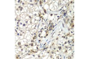 Immunohistochemistry of paraffin-embedded human kidney cancer using ASPSCR1 antibody.
