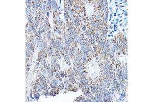 Immunohistochemistry of paraffin-embedded human colon carcinoma using SMOC1 antibody (ABIN7270511) at dilution of 1:250 (40x lens). (SMOC1 Antikörper  (AA 27-250))