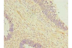 Immunohistochemistry of paraffin-embedded human ovarian cancer using ABIN7149808 at dilution of 1:100 (OTUD6B Antikörper  (AA 1-293))
