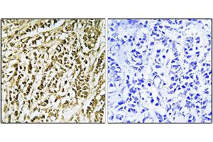 Immunohistochemistry analysis of paraffin-embedded human breast carcinoma tissue using FEN1 antibody. (FEN1 Antikörper)