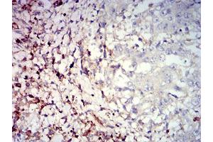 Immunohistochemical analysis of paraffin-embedded stomach cancer tissues using CD39 mouse mAb with DAB staining. (CD39 Antikörper  (AA 38-179))