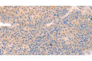 Immunohistochemistry of paraffin-embedded Human liver cancer tissue using CD109 Polyclonal Antibody at dilution 1:30 (CD109 Antikörper)