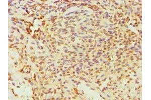 Immunohistochemistry of paraffin-embedded human breast cancer using ABIN7170761 at dilution of 1:100 (ESRRA Antikörper  (AA 1-423))
