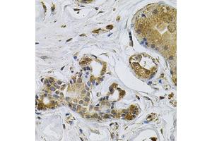 Immunohistochemistry of paraffin-embedded human breast cancer using NCF4 Antibody (ABIN5971122) at dilution of 1/100 (40x lens). (NCF4 Antikörper)