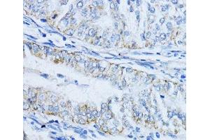Immunohistochemistry of paraffin-embedded Human colon carcinoma using VIL1 Polyclonal Antibody at dilution of 1:100 (40x lens).