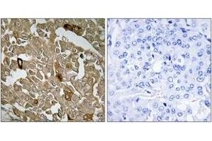 Immunohistochemistry analysis of paraffin-embedded human breast carcinoma tissue, using BTBD6 Antibody.