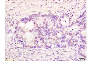 Formalin-fixed and paraffin embedded human colon carcinoma labeled with Anti PMS1 Polyclonal Antibody, Unconjugated (ABIN1387537) at 1:200 followed by conjugation to the secondary antibody and DAB staining (PMS1 Antikörper  (AA 21-120))