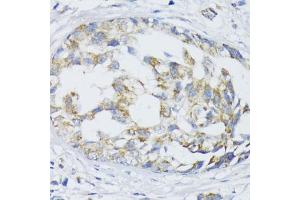 Immunohistochemistry of paraffin-embedded human mammary cancer using SLC30 antibody (2532) at dilution of 1:100 (40x lens). (SLC30A1 Antikörper  (AA 250-350))