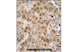 Formalin-fixed and paraffin-embedded human hepatocarcinoma tissue reacted with DDX5 antibody (C-term) (ABIN391668 and ABIN2841579) , which was peroxidase-conjugated to the secondary antibody, followed by DAB staining. (DDX5 Antikörper  (C-Term))