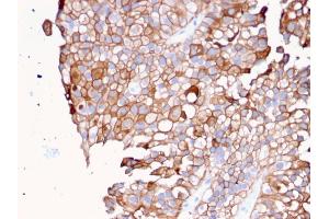 Formalin-fixed, paraffin-embedded human Urothelial Carcinoma stained with Uroplakin 1B Mouse Monoclonal Antibody (UPK1B/3081). (Uroplakin 1B Antikörper  (AA 109-229))