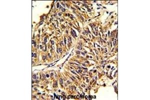 Formalin-fixed and paraffin-embedded human lung carcinoma reacted with HMGCS1 Antibody (Center), which was peroxidase-conjugated to the secondary antibody, followed by DAB staining. (HMGCS1 Antikörper  (AA 290-317))