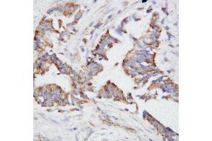 Anti-Osteopontin antibody, IHC(P) IHC(P): Human Mammary Cancer Tissue (Osteopontin Antikörper  (N-Term))
