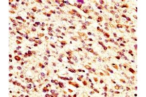 IHC image of ABIN7159800 diluted at 1:300 and staining in paraffin-embedded human glioma performed on a Leica BondTM system. (m1ip1 Antikörper  (AA 1-183))