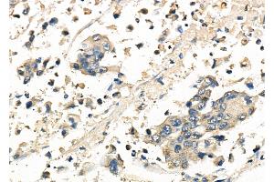 ABIN6261815 and ABIN6278146 at 1/100 staining Human gastric cancer by IHC-P. (FRAT1 Antikörper  (C-Term))