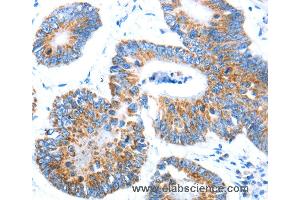 Immunohistochemistry of Human colon cancer using AIFM1 Polyclonal Antibody at dilution of 1:30 (AIF Antikörper)