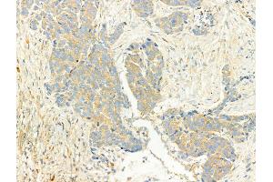 ABIN6266056 and ABIN6268656 at 1/100 staining Human breast cancer by IHC-P. (XBP1 Antikörper  (C-Term))
