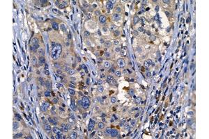 ABIN6262625 and ABIN6268687 at 1/100 staining Human ovarian cancer by IHC-P.