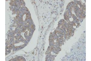 IHC-P Image Immunohistochemical analysis of paraffin-embedded human endo mitral ovarian cancer, using NMI, antibody at 1:100 dilution. (NMI Antikörper)