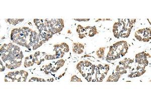 Immunohistochemistry of paraffin-embedded Human esophagus cancer tissue using EEF1E1 Polyclonal Antibody at dilution of 1:35(x200) (EEF1E1 Antikörper)