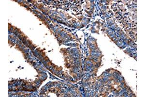 The image on the left is immunohistochemistry of paraffin-embedded Human cervical cancer tissue using ABIN7190708(FPR2 Antibody) at dilution 1/17, on the right is treated with synthetic peptide. (FPR2 Antikörper)