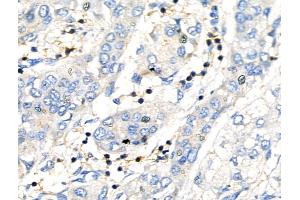 ABIN6260619 and ABIN6276857 at 1/100 staining Human liver cancer by IHC-P. (CD3 epsilon Antikörper  (C-Term))