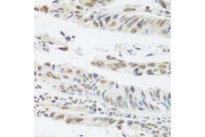 Immunohistochemistry of paraffin-embedded human colon carcinoma using SNAI1 antibody. (SNAIL Antikörper)