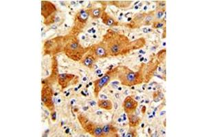 Formalin-fixed and paraffin-embedded human hepatocarcinoma reacted with Glucagon Antibody (N-term), Cat. (Glucagon Antikörper  (N-Term))