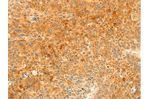 The image on the left is immunohistochemistry of paraffin-embedded Human liver cancer tissue using ABIN7131139(SOCS6 Antibody) at dilution 1/35, on the right is treated with fusion protein. (SOCS6 Antikörper)