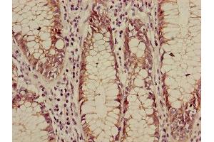 Immunohistochemistry of paraffin-embedded human colon cancer using ABIN7146984 at dilution of 1:100 (CTNNB1 Antikörper  (AA 2-781))
