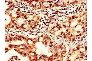 Immunohistochemistry of paraffin-embedded human lung cancer using ABIN7175942 at dilution of 1:100 (YTHDF2 Antikörper  (AA 201-500))