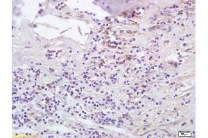 Formalin-fixed and paraffin embedded human lung carcinoma labeled with Anti-CCL5/RANTES Polyclonal Antibody, Unconjugated (ABIN674949) at 1:200 followed by conjugation to the secondary antibody and DAB staining.