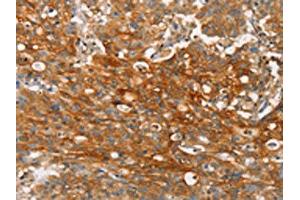 The image on the left is immunohistochemistry of paraffin-embedded Human gastic cancer tissue using ABIN7190272(CLDN11 Antibody) at dilution 1/25, on the right is treated with synthetic peptide. (Claudin 11 Antikörper)